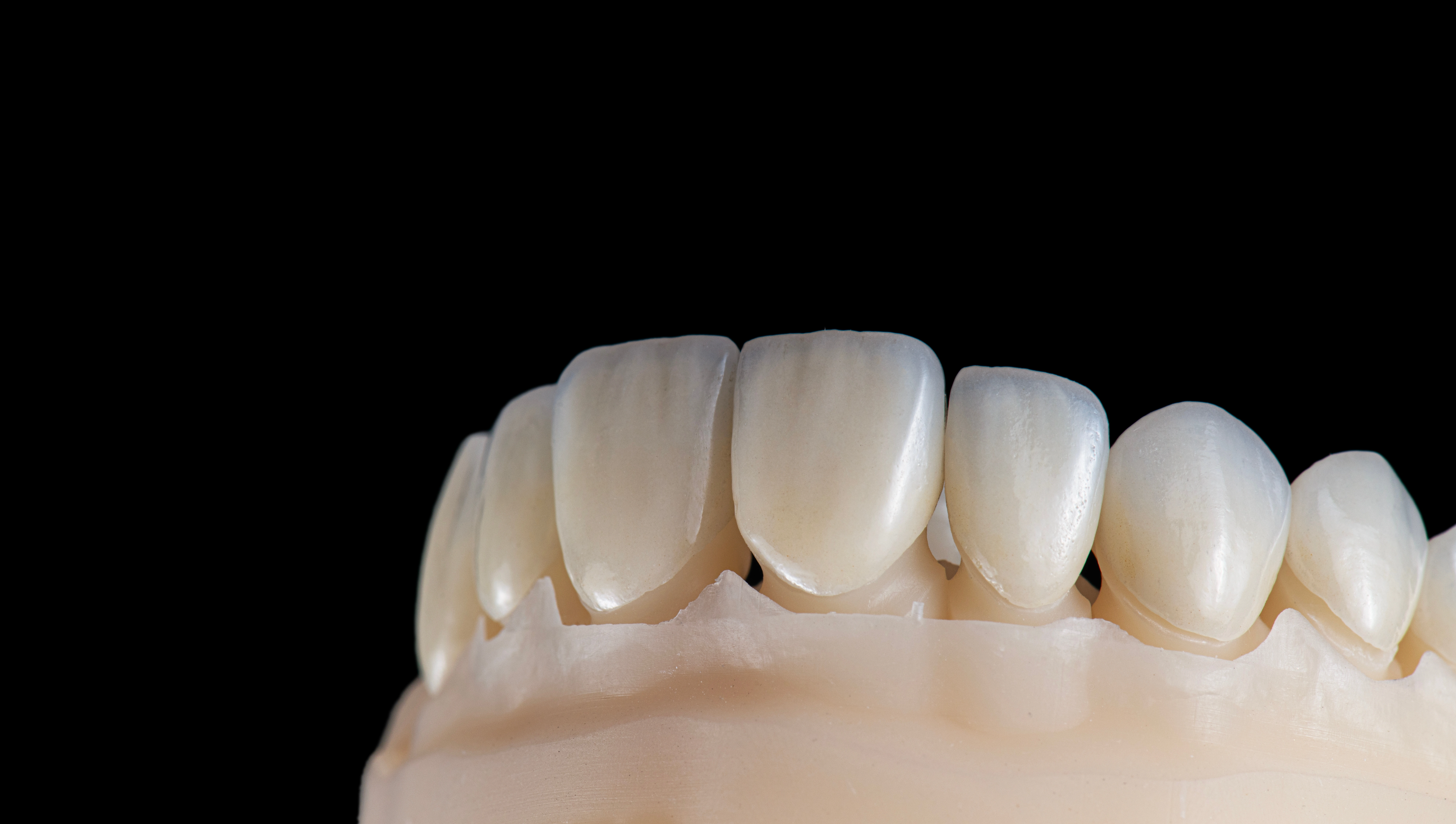 Porcelain Laminate Veneers